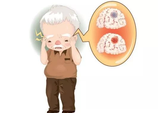 择思达斯_出现脑萎缩有哪些症状怎么治疗?